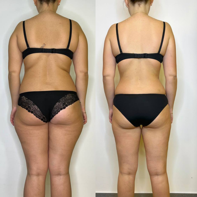 Схуднення антицелюлітний масаж